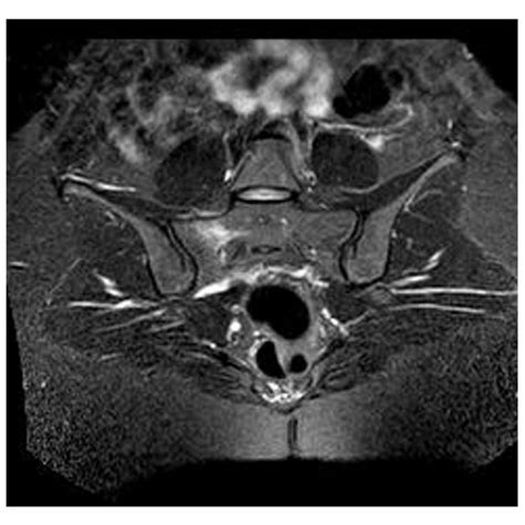 MRI T2 axial scan showed bone marrow edema at the sacrum. | Download ...