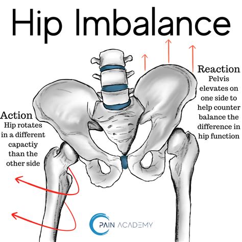 Hip Imbalance – Pain Academy