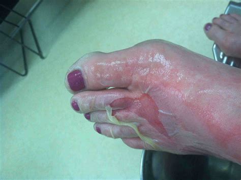 2nd-Degree Burns: Healing Stages, Pictures, Causes, Treatment