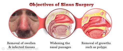 Sinus Surgery - Facts, Preparation, Operative Procedure, Recovery ...