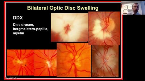 Con fecha de impaciente Tableta optic nerve edema causes Tercero ...