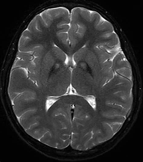 MRI Brain Scans Detect People with Early Parkinson’s – Neuroscience News