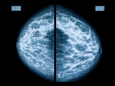 Abnormal Mammogram? 7 Questions to Ask Your Doctor | The Healthy