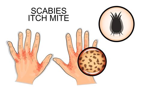 Scabies | Causes, Symptoms, Treatment, Pictures & Images