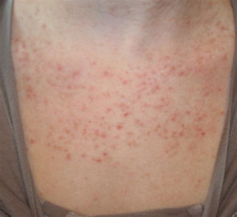 keratosis pilaris images - pictures, photos