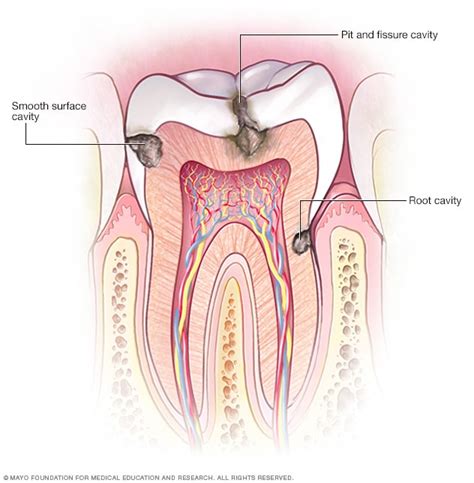 Types of cavities - Mayo Clinic