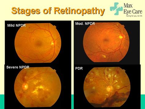 stages of diabetic retinopathy | Rohan Chawla | Flickr