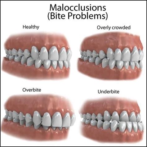 "Hereditary factors may cause malocclusion problems such as crossbite ...