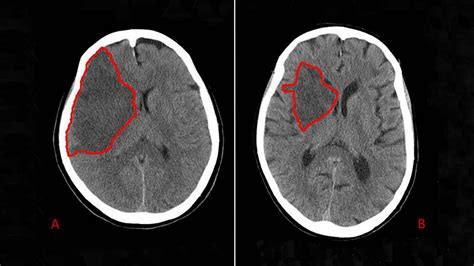 Stroke Ct Scan