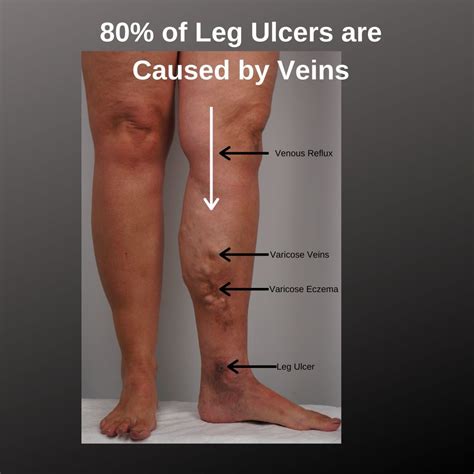 What do Leg Ulcers Look Like? | The VeinCare Centre