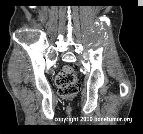 Extensive pelvic metastasis from thyroid cancer | BoneTumor.org