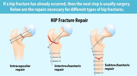 Broken Hip: Types, Causes and Symptoms | CareLinx