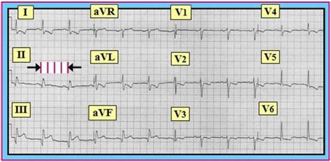 ECG Interpretation: ECG Interpretation Review - #7 (Infarction, ECG ...