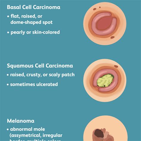 Skin Cancer: Signs, Symptoms, and Complications