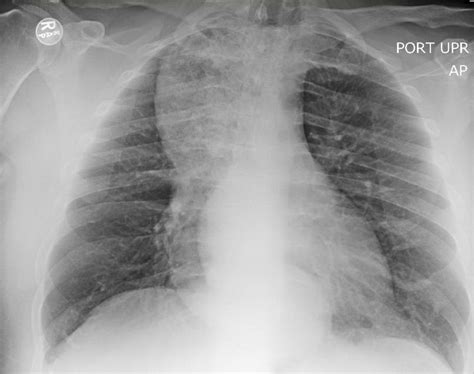 Achalasia. Plain Film Chest Xray. Unannotated. JETem 2018 - JETem