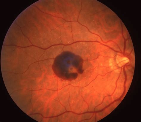 An Overview of Macular Degeneration | EyeDocs Family Eye Care