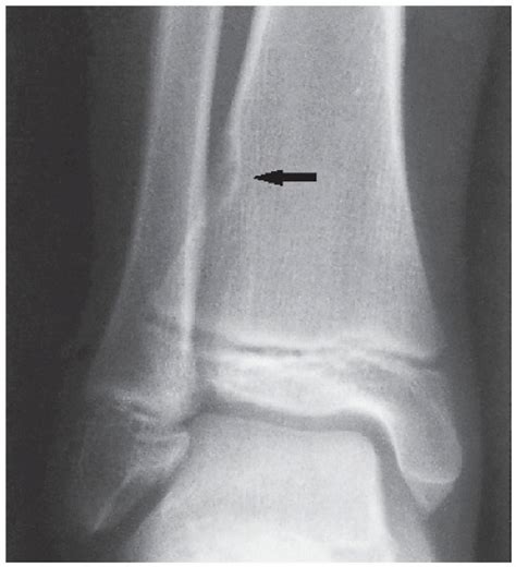 Benign Tumors and Tumor-like Lesions III: Fibrous, Fibroosseus, and ...