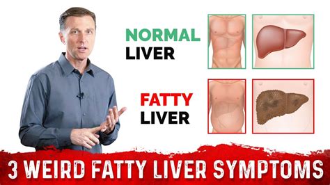 How To Check For Fatty Liver - Askexcitement5