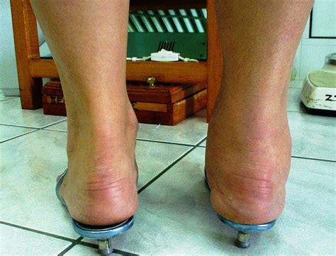 Rheumatoid arthritis in the ankles: Symptoms and treatment