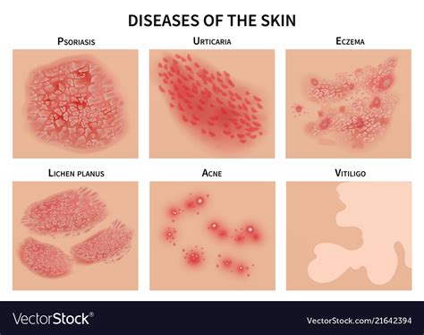 Skin diseases derma infection eczema and Vector Image