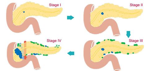 Pancreatic Cancer Staging | Modern Cancer Hospital Guangzhou, China