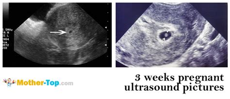 3 weeks pregnant ultrasound pictures