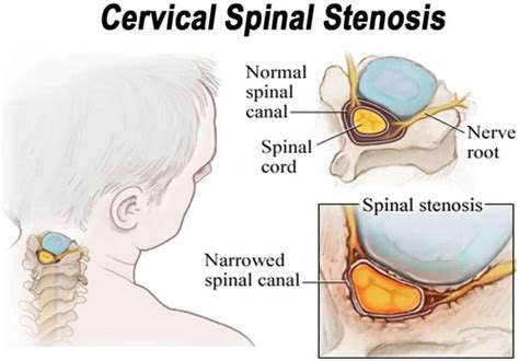 Spinal stenosis causes, symptoms, diagnosis, treatment and exercises