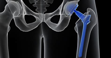 Hip Replacement Surgery - Pontchartrain Orthopedics