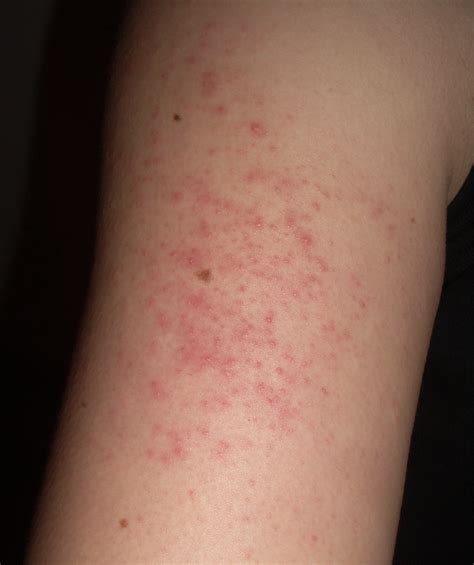 File:Keratosis pilaris arm.jpg - Wikipedia