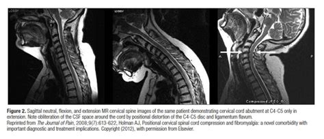 Prevalence of MRI Findings in the Cervical Spine – Chiropractic ...