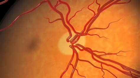 What Causes Optic Nerve Damage?