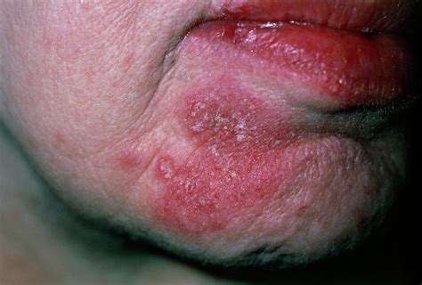 Facial Rash Of Systemic Lupus Erythematosus (sle) Photograph by Dr P ...