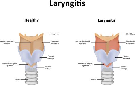 Chronic Pharyngitis: Symptoms, Causes, Home Remedies | STD.GOV Blog