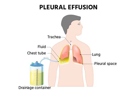 Pleural Effusion: Causes, Symptoms & Treatment