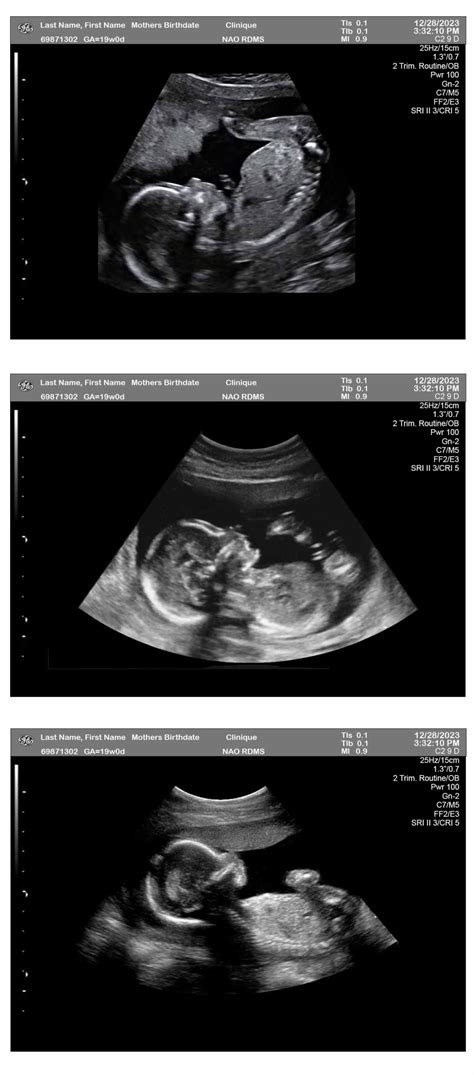 19 Weeks Ultrasound Boy 3-Fetuses - Ultrasounds