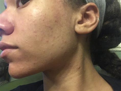 Small bumps all over face? Help!! - General acne discussion - Acne.org