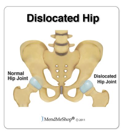 Hip Dislocation Information