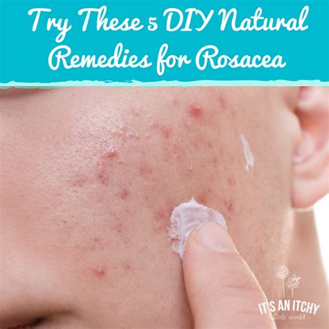 Try These 5 DIY Natural Remedies for Rosacea - It's an Itchy Little World