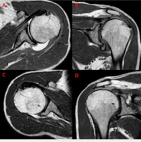 Bilateral shoulder MRI showing irreparable rotator cuff tear on axial ...