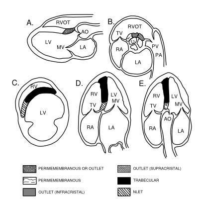 Ventricular Septal Defect (VSD) | Cardiac sonography, Cardiac anatomy ...