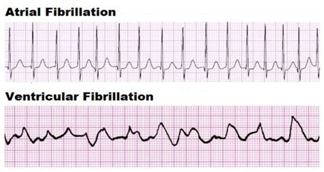 Difference Between Atrial Fibrillation And Ventricular, 47% OFF