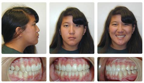 Orthodontic Before and After Photos | Brodsky Orthodontics