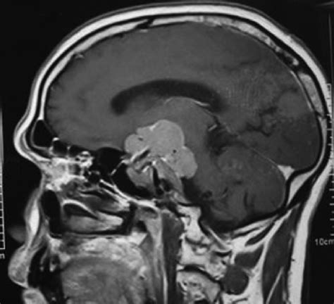 MRI brain (sagittal section) showing invasive giant prolactinoma with ...