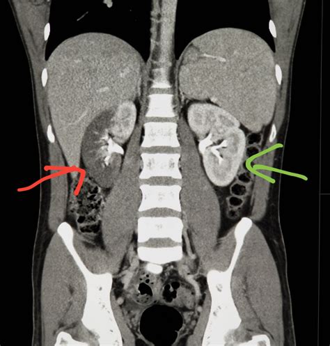 #Abdomen #CT shows #blood flow blocked to the #kidney (red: #renal # ...