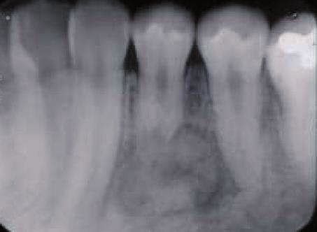 Periapical radiograph of cementoblastoma associated with the left ...