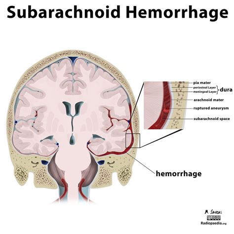 Hémorragie sous arachnoïdienne / méningée – PinkyBone