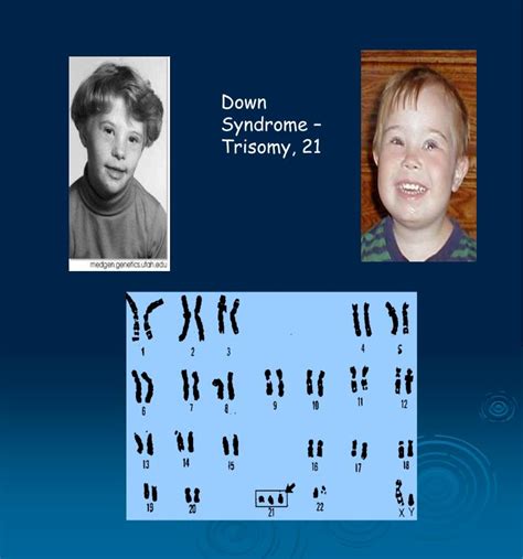 Trisomy 21 Down Syndrome - Down Syndrome (Trisomy 21) : A child with ...