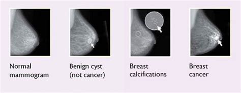 Pictures of Breast Cancer Lumps: How To Identify Warning Signs