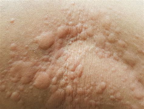 What are hives, the common skin condition that gives you itchy, red ...