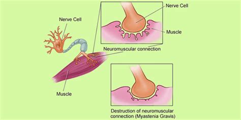 Myasthenia Gravis - Causes, Symptoms, Diagnosis and its Treatment